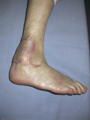 Symptoms and Diagnosis of Pyoderma Gangrenosum - DHealthWellness ...