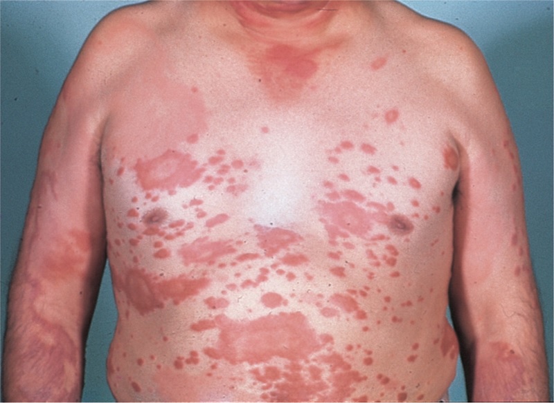 Type Of Leprosy Skin Lesions DHealthWellness Everything About 